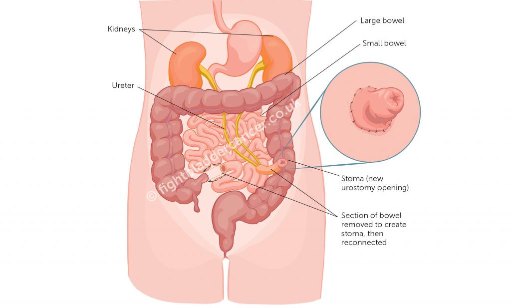 Diagram of the formation of a stoma from the bowel
